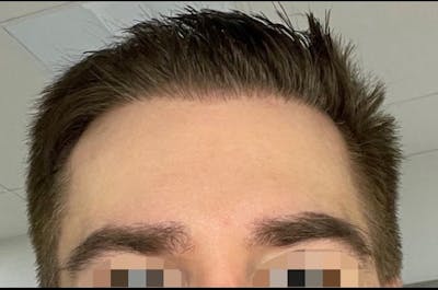 Eyebrow Transplantation Before & After Gallery - Patient 245934 - Image 2