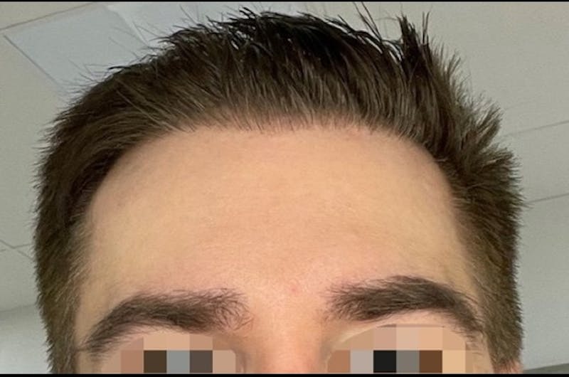Eyebrow Transplantation Before & After Gallery - Patient 347480 - Image 2