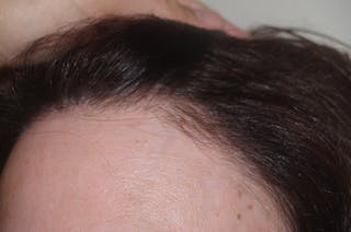 Hair Procedures for Women Before & After Gallery - Patient 111009 - Image 2
