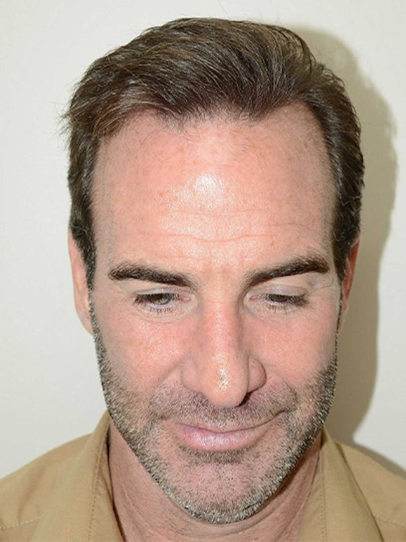 Hair Restoration for Men Before & After Gallery - Patient 230810 - Image 2