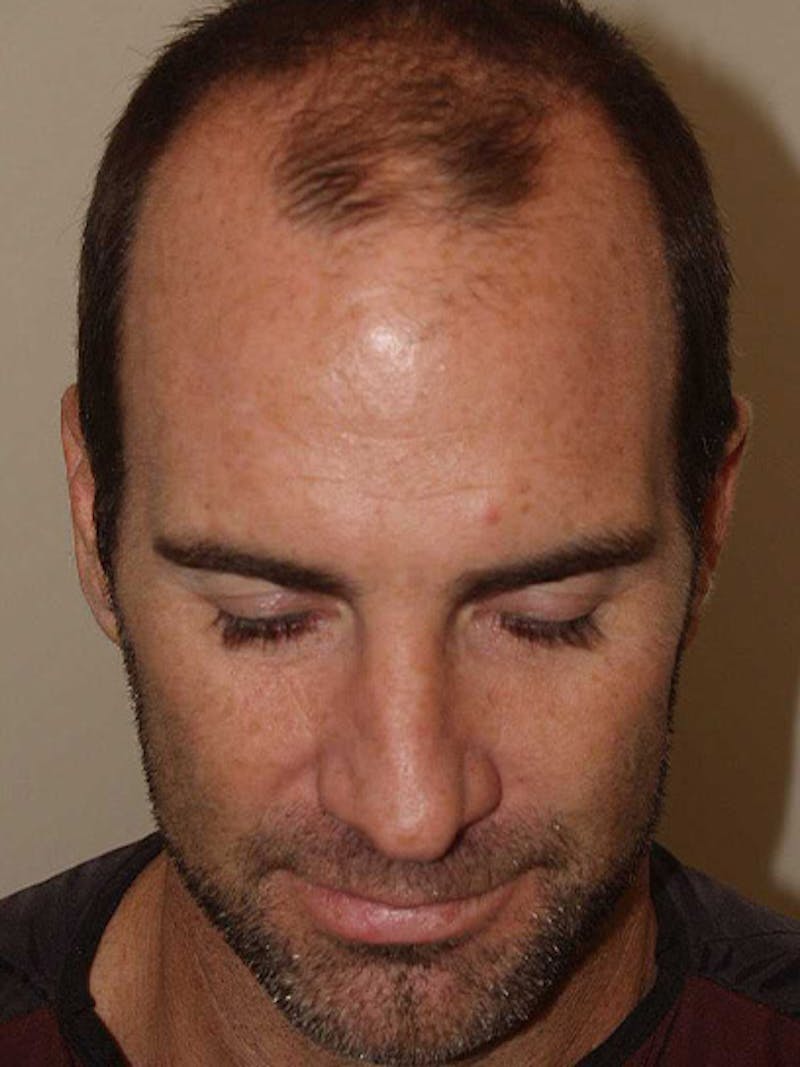 Hair Restoration for Men Before & After Gallery - Patient 230810 - Image 3