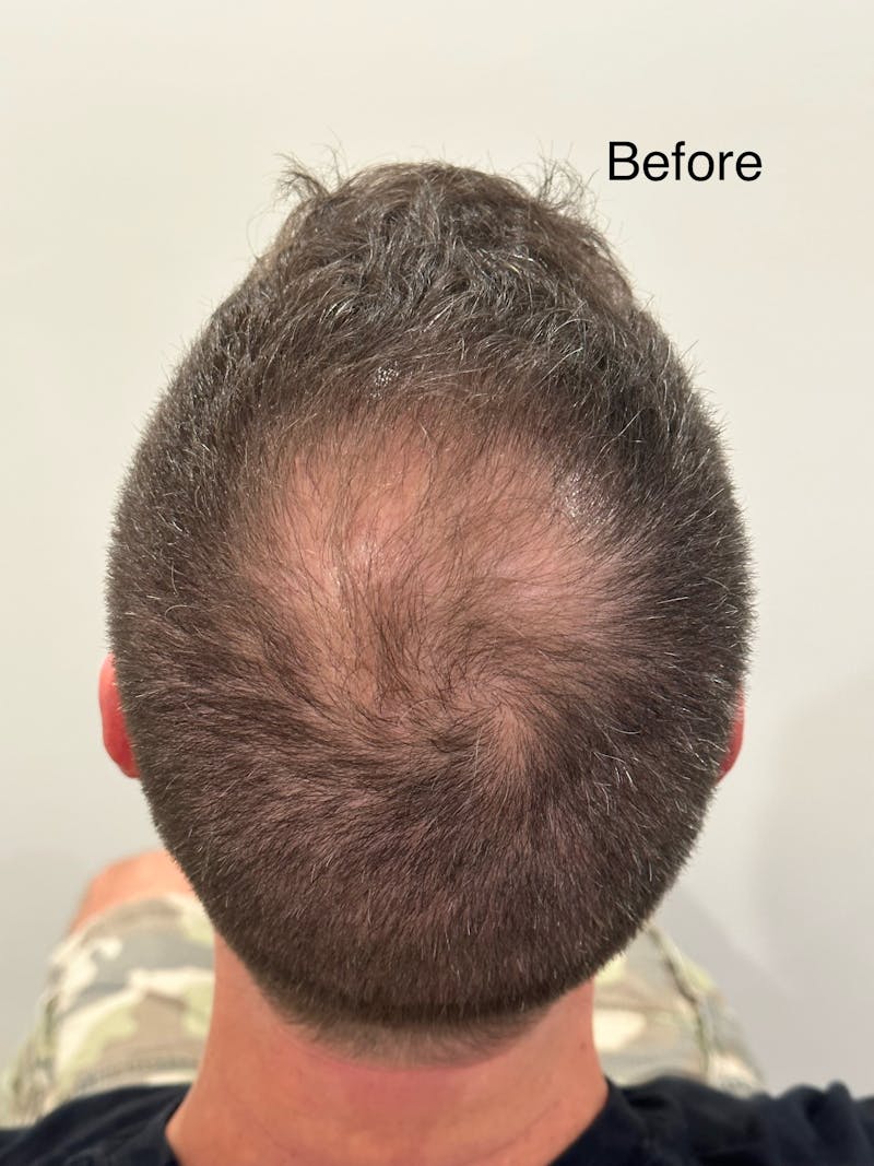 Scalp Micropigmentation Procedures Before & After Gallery - Patient 147319 - Image 1