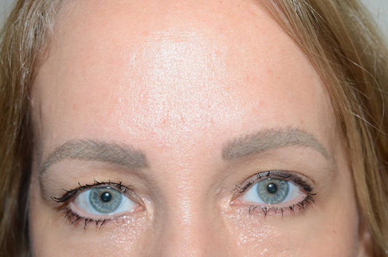Eyebrow Transplantation Before & After Gallery - Patient 231659 - Image 1
