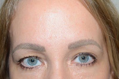 Eyebrow Transplantation Before & After Gallery - Patient 351132 - Image 1