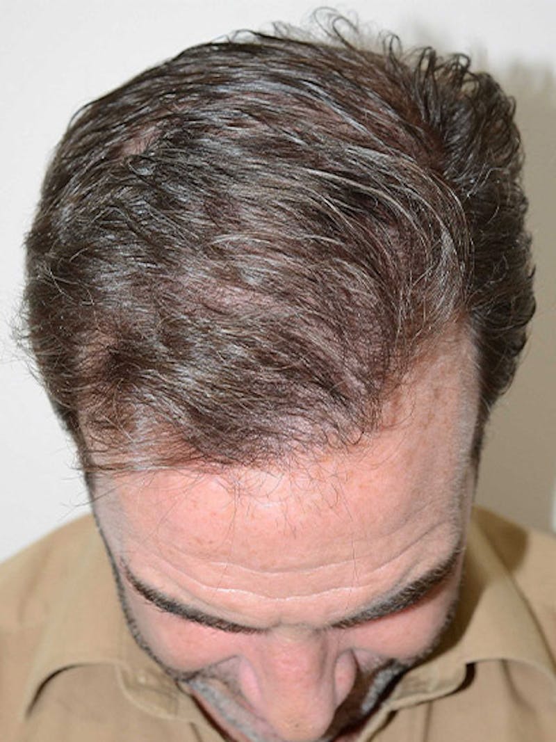 Hair Restoration for Men Before & After Gallery - Patient 230810 - Image 4