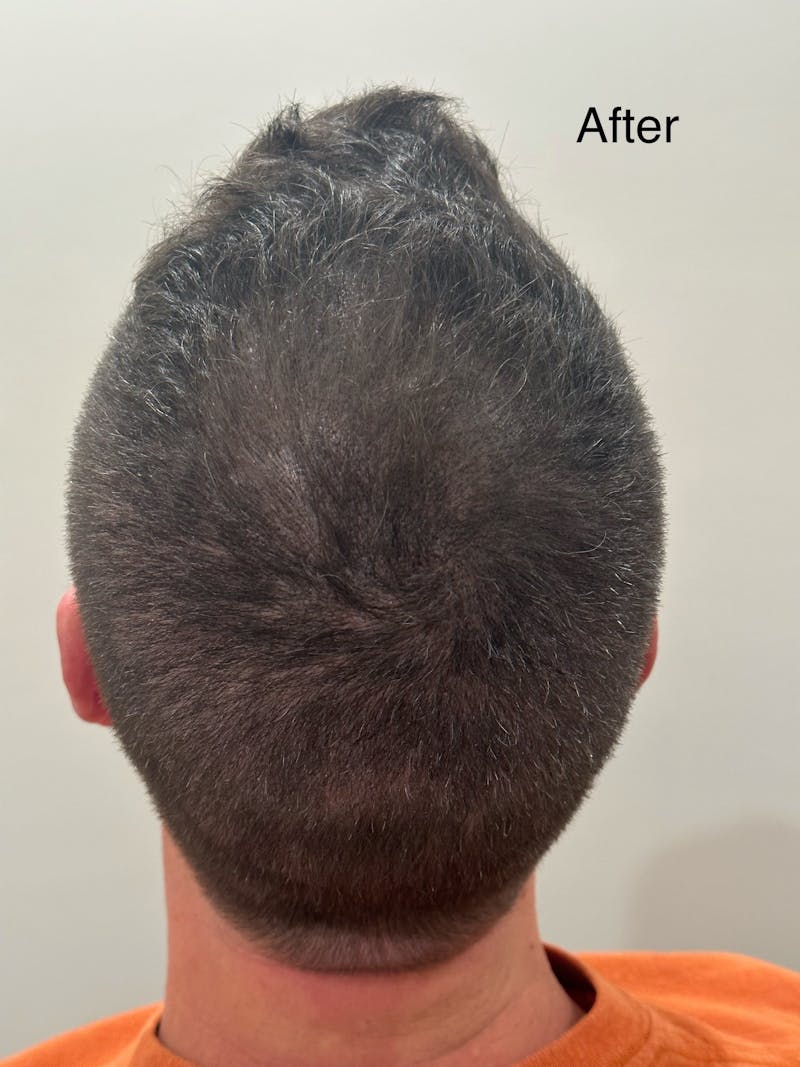 Scalp Micropigmentation Procedures Before & After Gallery - Patient 147319 - Image 2