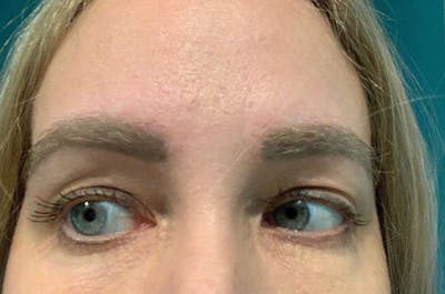 Eyebrow Transplantation Before & After Gallery - Patient 351132 - Image 2