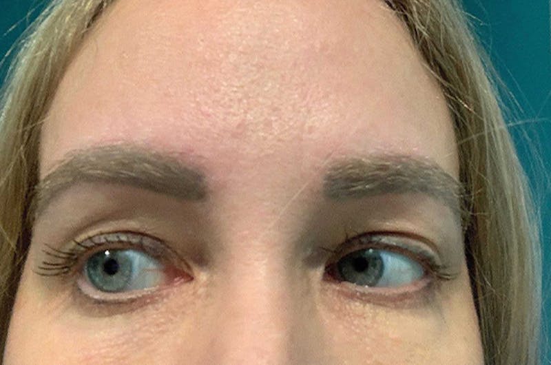 Eyebrow Transplantation Before & After Gallery - Patient 231659 - Image 2
