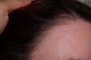 Hair Procedures for Women Before & After Gallery - Patient 111009 - Image 4