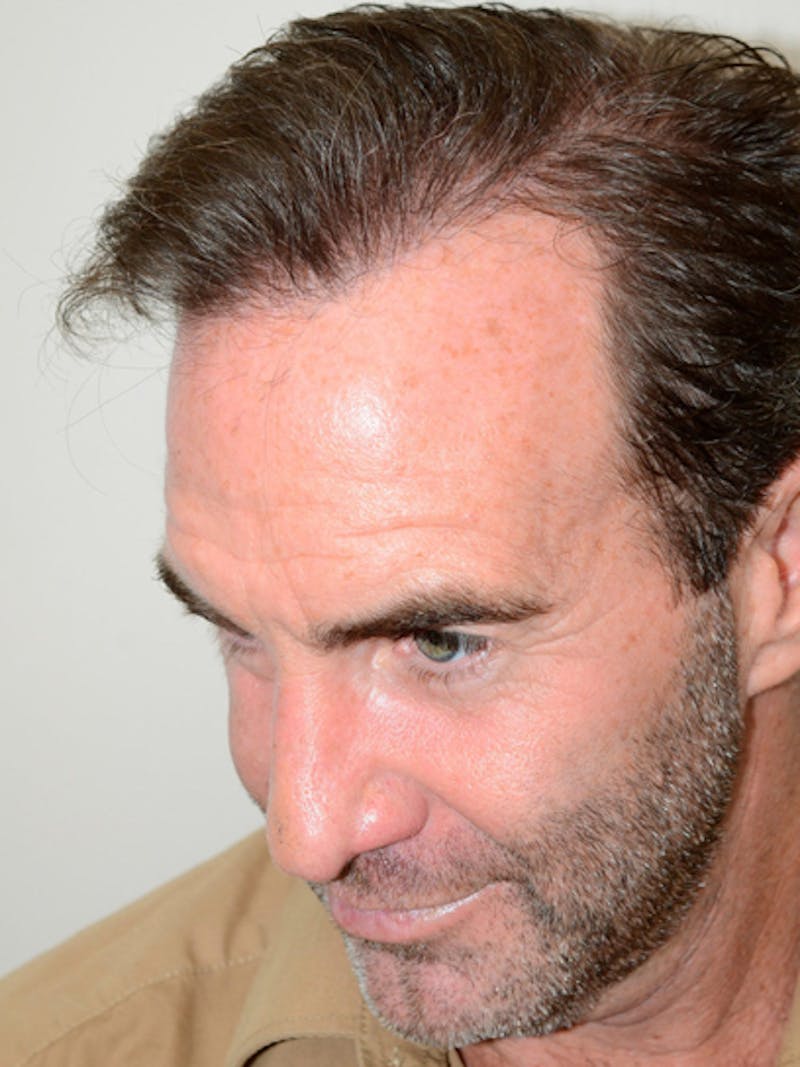 Hair Restoration for Men Before & After Gallery - Patient 230810 - Image 6