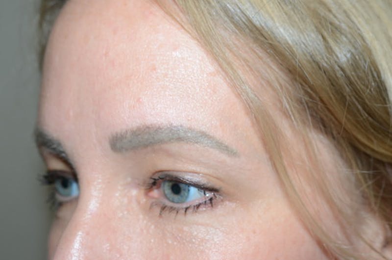 Eyebrow Transplantation Before & After Gallery - Patient 231659 - Image 3