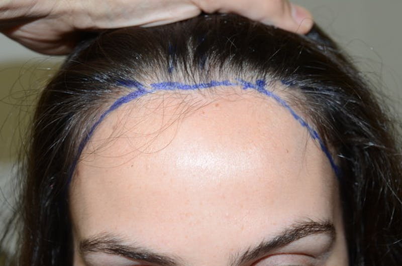 Hair Procedures for Women Before & After Gallery - Patient 494011 - Image 1