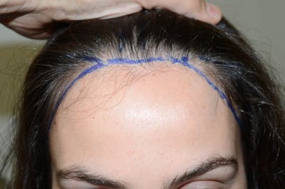 Hair Procedures for Women Before & After Gallery - Patient 174873 - Image 1