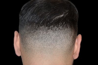 Hair Restoration for Men Before & After Gallery - Patient 705198 - Image 1