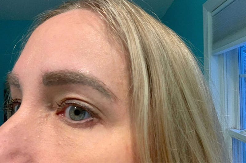 Eyebrow Transplantation Before & After Gallery - Patient 231659 - Image 4