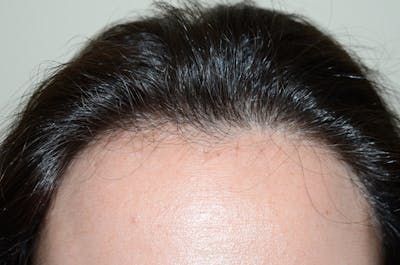 Hair Procedures for Women Before & After Gallery - Patient 174873 - Image 2
