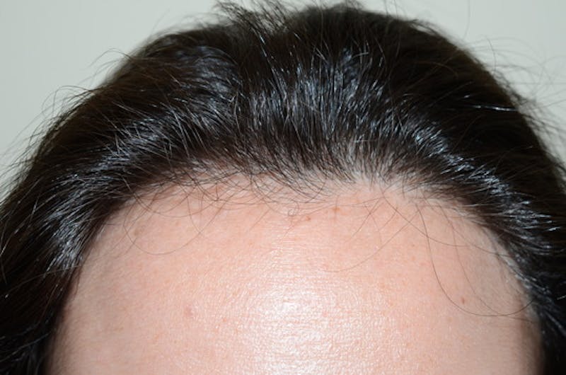 Hair Procedures for Women Before & After Gallery - Patient 494011 - Image 2