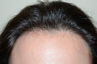 Hair Procedures for Women Before & After Gallery - Patient 494011 - Image 2