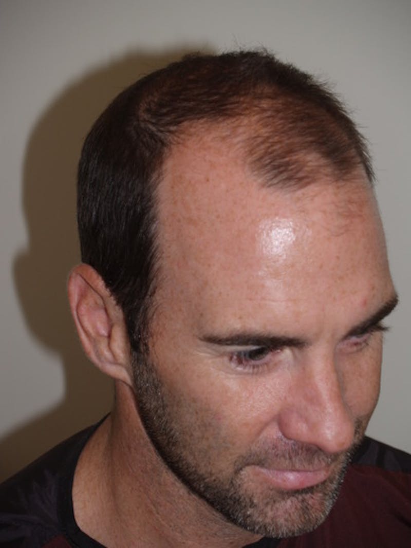 Hair Restoration for Men Before & After Gallery - Patient 230810 - Image 7