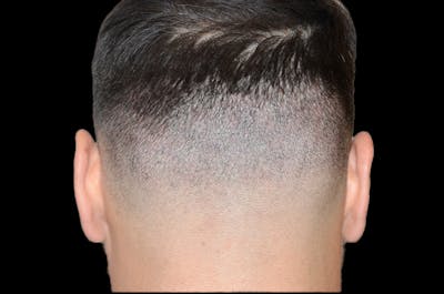 Hair Restoration for Men Before & After Gallery - Patient 705198 - Image 2