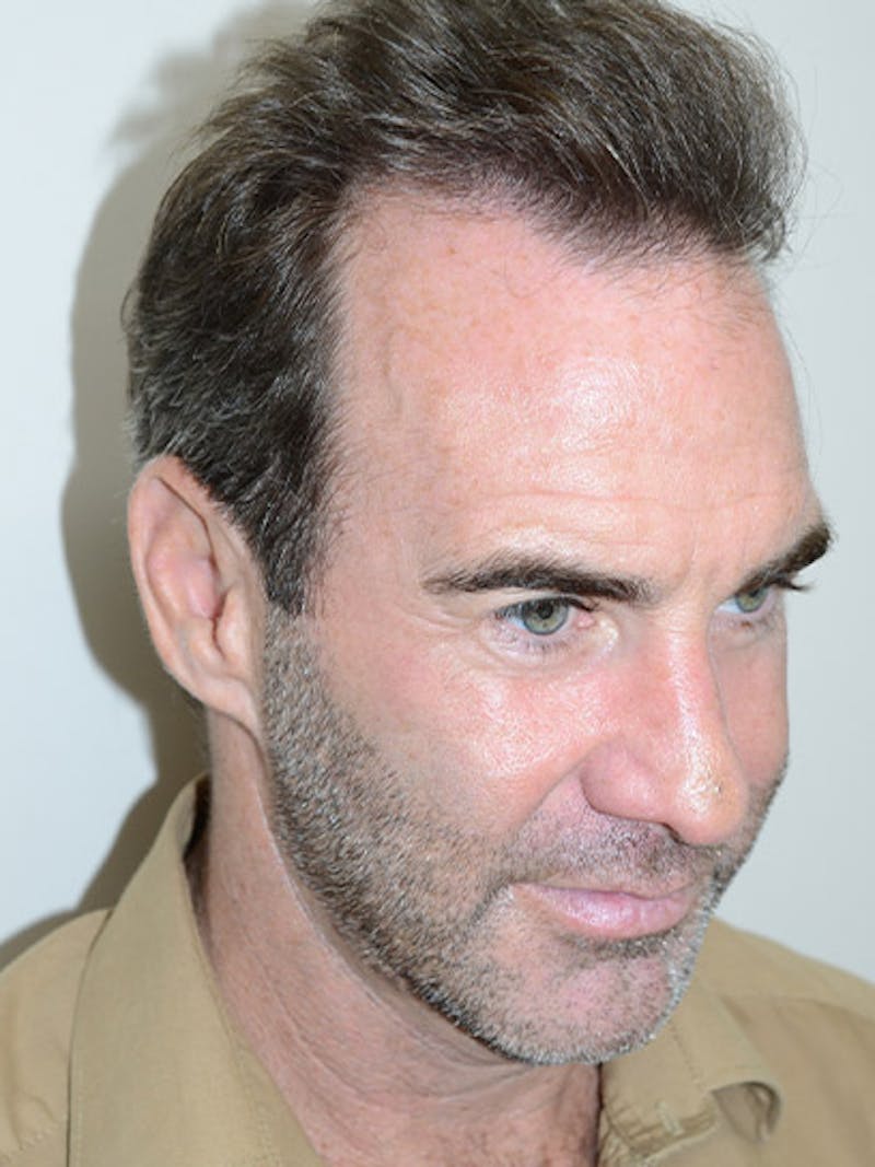 Hair Restoration for Men Before & After Gallery - Patient 230810 - Image 8
