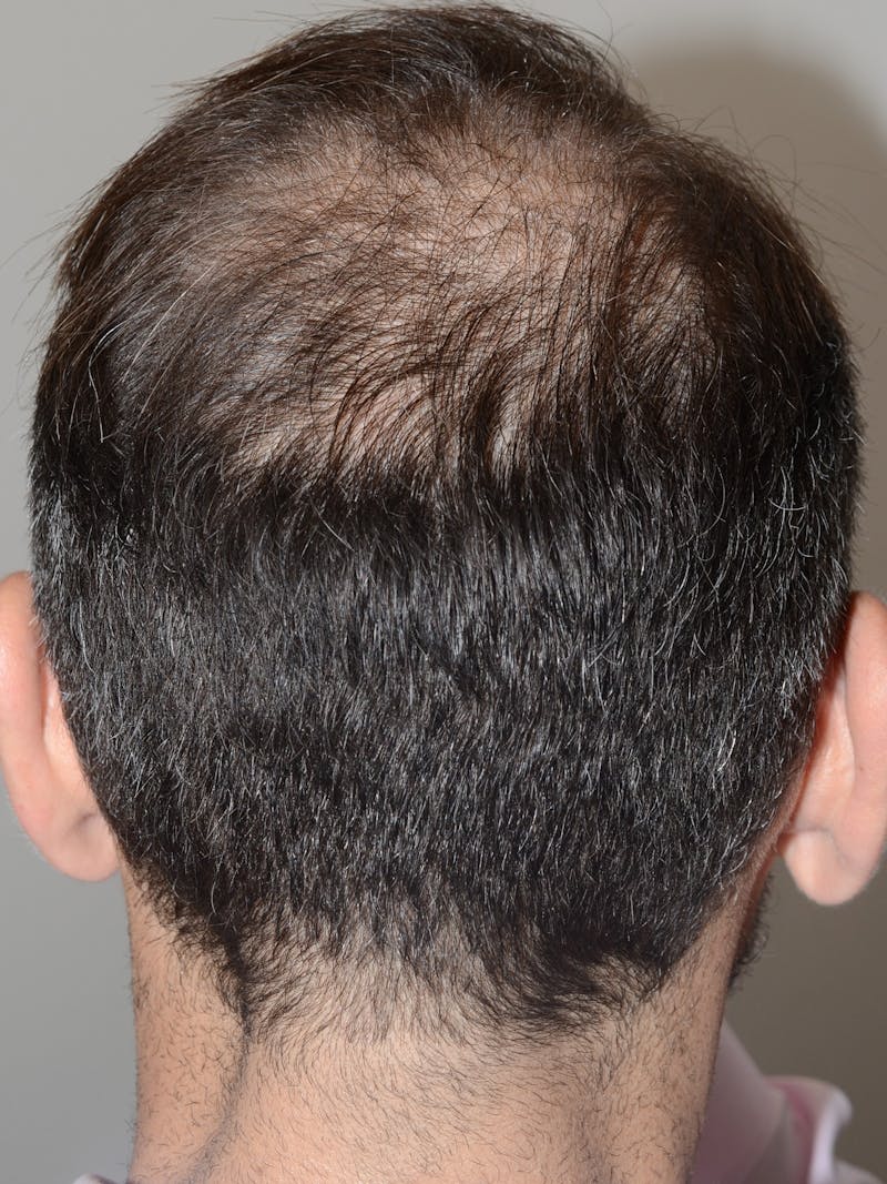Scalp Micropigmentation Procedures Before & After Gallery - Patient 657954 - Image 1
