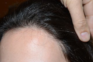 Hair Procedures for Women Before & After Gallery - Patient 494011 - Image 4