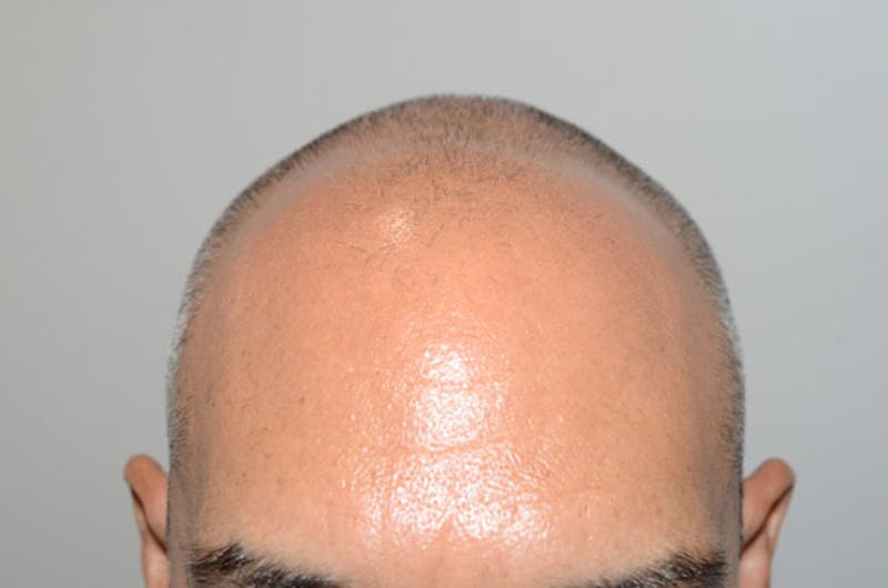 Hair Restoration for Men Before & After Gallery - Patient 509094 - Image 1