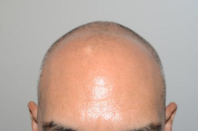 Hair Restoration for Men Before & After Gallery - Patient 131760 - Image 1