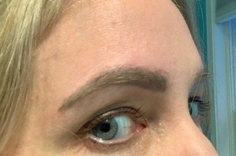 Eyebrow Transplantation Before & After Gallery - Patient 231659 - Image 6