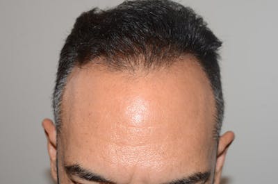 Hair Restoration for Men Before & After Gallery - Patient 131760 - Image 2