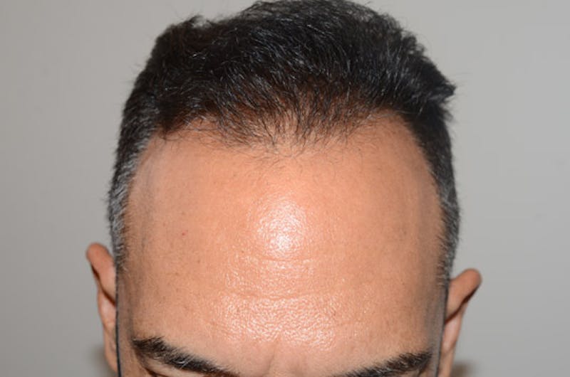 Hair Restoration for Men Before & After Gallery - Patient 509094 - Image 2