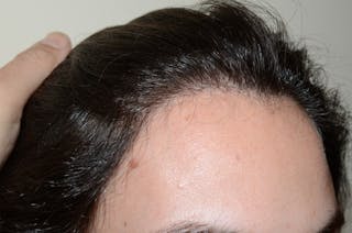 Hair Procedures for Women Before & After Gallery - Patient 494011 - Image 6