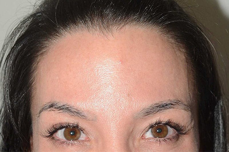 Eyebrow Transplantation Before & After Gallery - Patient 251957 - Image 1