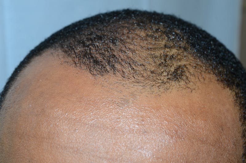 Scalp Micropigmentation Procedures Before & After Gallery - Patient 121271 - Image 1