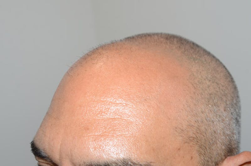 Hair Restoration for Men Before & After Gallery - Patient 509094 - Image 3