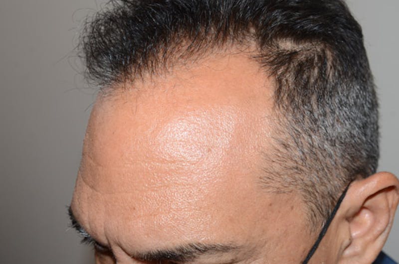 Hair Restoration for Men Before & After Gallery - Patient 509094 - Image 4