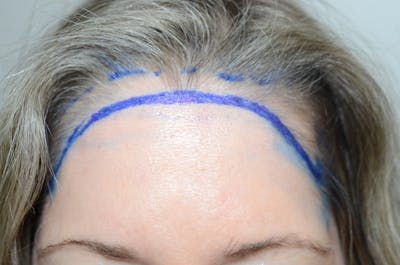 Hair Procedures for Women Before & After Gallery - Patient 132998 - Image 1
