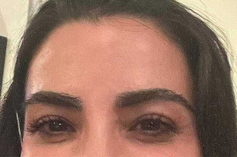 Eyebrow Transplantation Before & After Gallery - Patient 251957 - Image 2