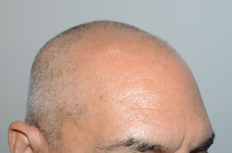 Hair Restoration for Men Before & After Gallery - Patient 509094 - Image 5