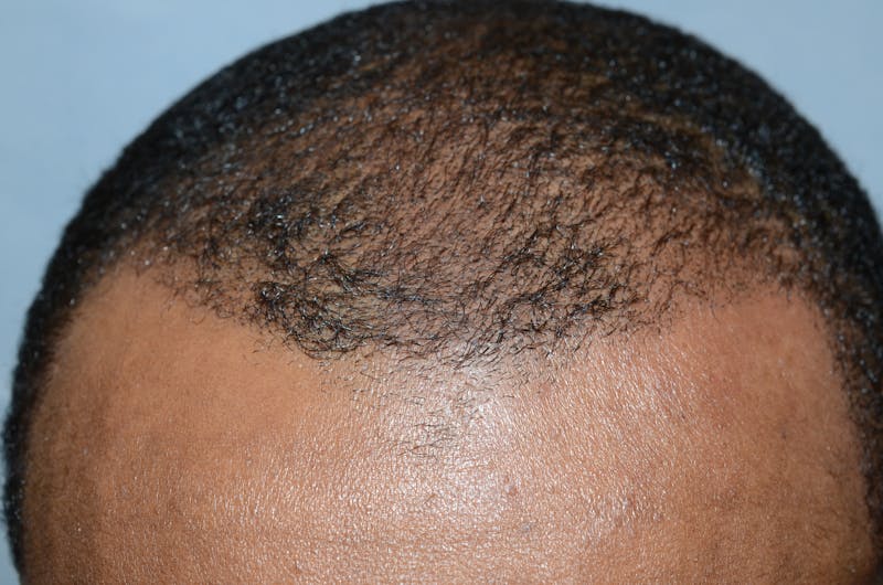 Scalp Micropigmentation Procedures Before & After Gallery - Patient 121271 - Image 2