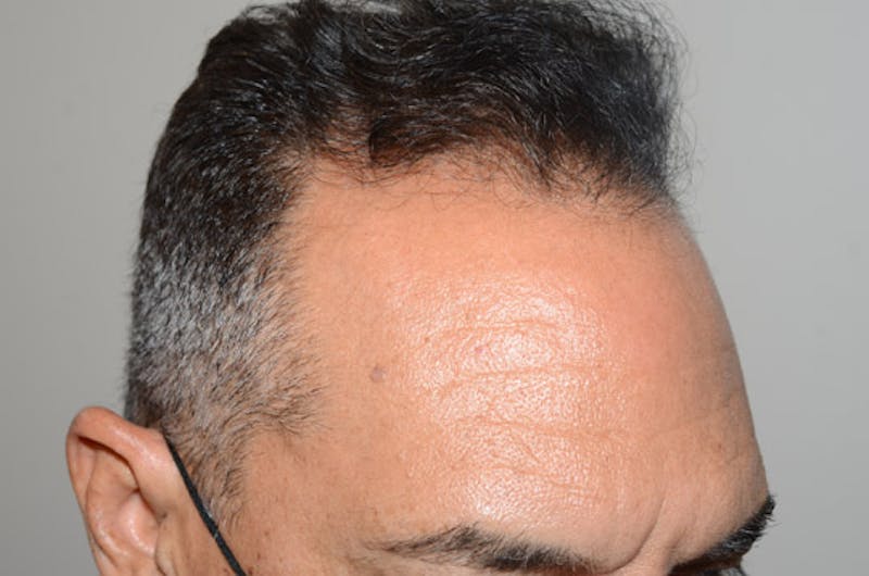 Hair Restoration for Men Before & After Gallery - Patient 509094 - Image 6