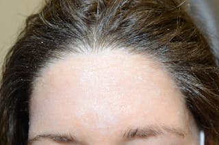 Hair Procedures for Women Before & After Gallery - Patient 319595 - Image 2