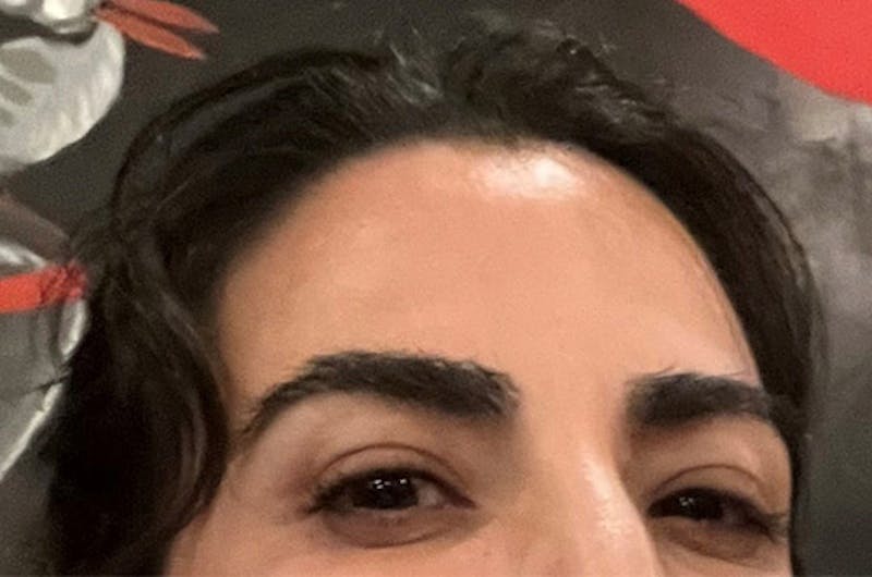 Eyebrow Transplantation Before & After Gallery - Patient 251957 - Image 4