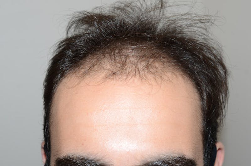 Hair Restoration for Men Before & After Gallery - Patient 267913 - Image 1