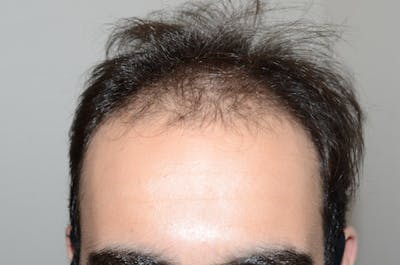 Hair Restoration for Men Before & After Gallery - Patient 211230 - Image 1