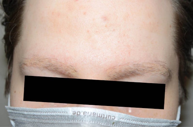 Eyebrow Transplantation Before & After Gallery - Patient 133300 - Image 1