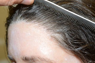 Hair Procedures for Women Before & After Gallery - Patient 319595 - Image 4
