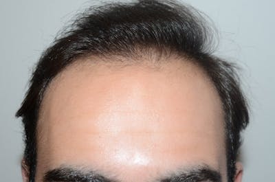 Hair Restoration for Men Before & After Gallery - Patient 211230 - Image 2