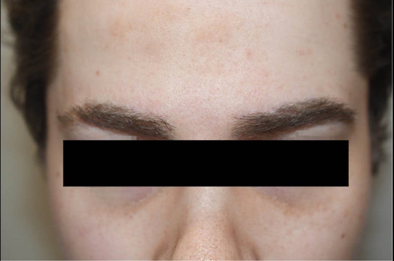 Eyebrow Transplantation Before & After Gallery - Patient 133300 - Image 2